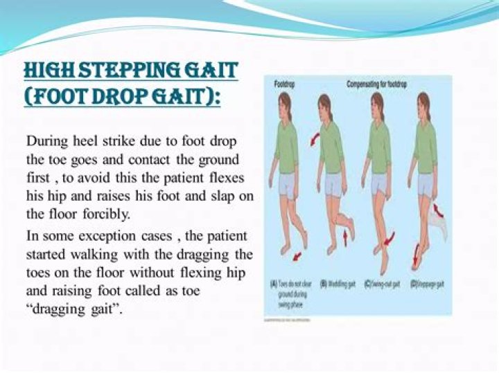 Why high stepping gait?