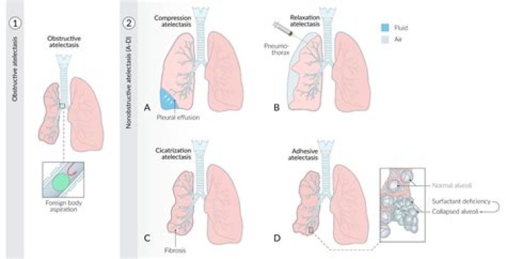 Why is atelectasis common after surgery?