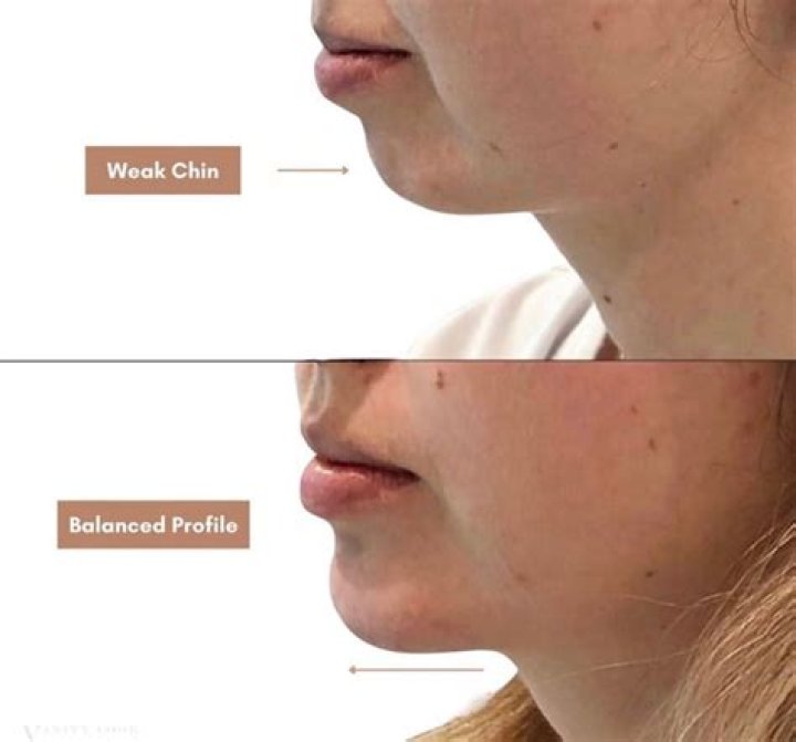 Why is my chin so prominent?