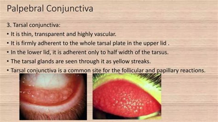 Why is my palpebral conjunctiva red?