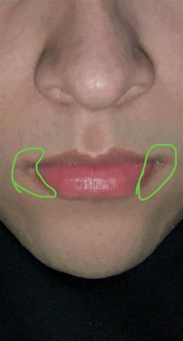 Why is there darkening around my mouth?