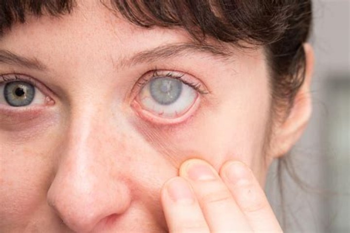 Why is trachoma rare in the united states?