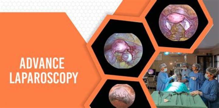 Why laparoscopy is done for pcos?