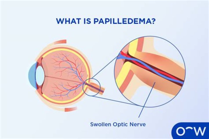 Why may a brain tumour produce papilloedema?