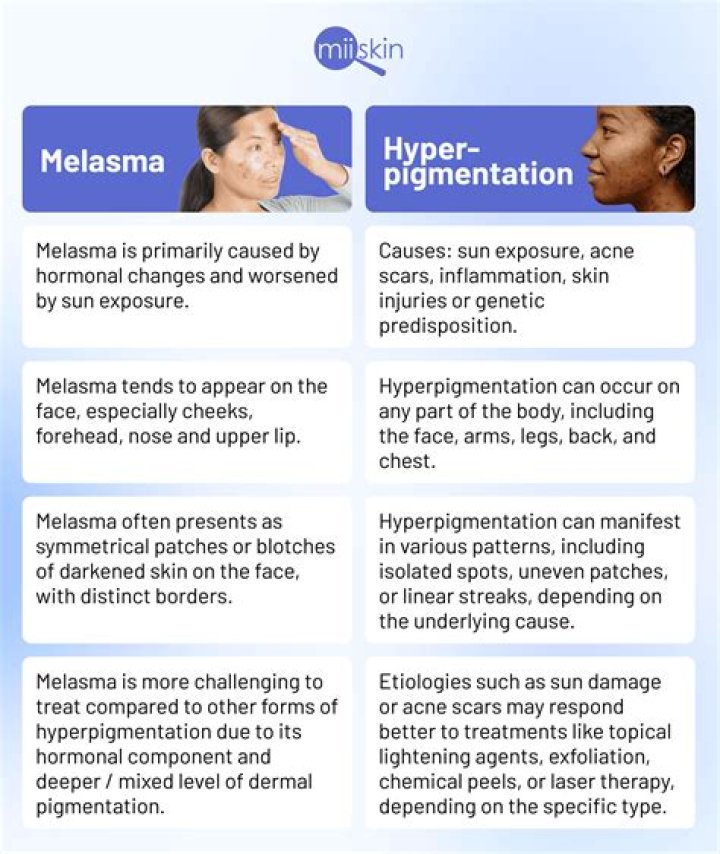 Why melasma occurs on face?