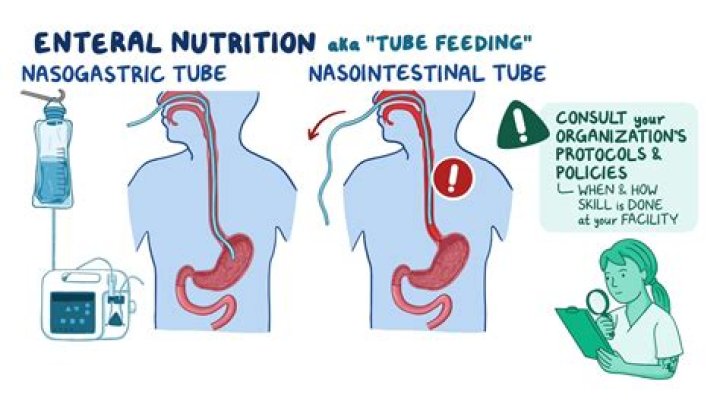 Why ng tube suction?