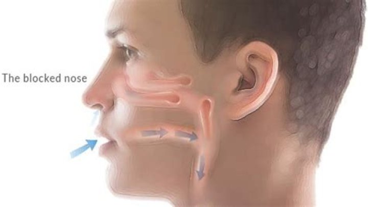 Why nose blockage happens?