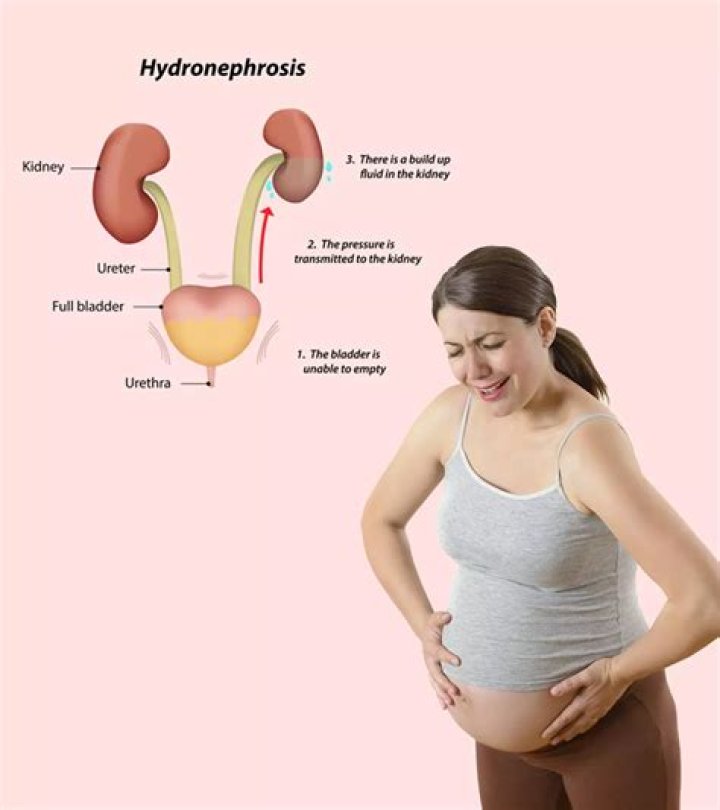 Why right hydronephrosis in pregnancy?