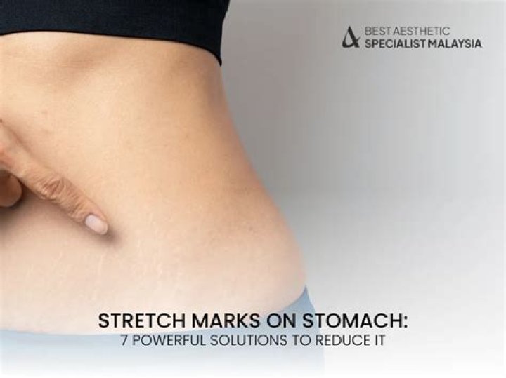 Why stretch marks on stomach?