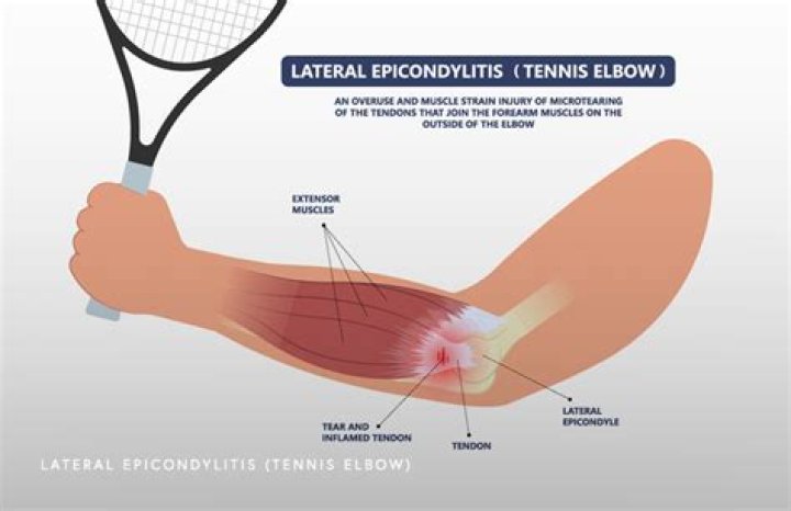Why tennis elbow happens?