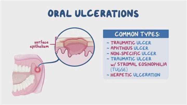 Why ulcer occur in mouth?