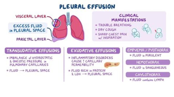 Why vocal fremitus decreased in pleural effusion?