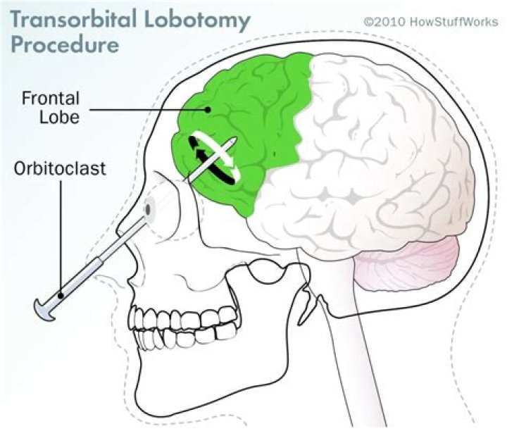 Why were prefrontal lobotomies performed?