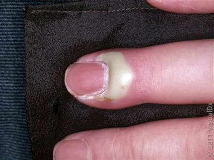 Will a hangnail infection heal on its own?