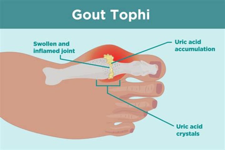 Will allopurinol get rid of gout?