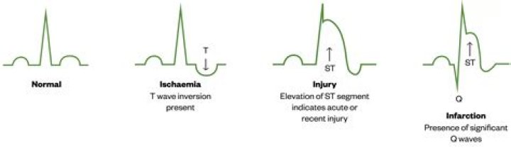 Will angina show on ecg?