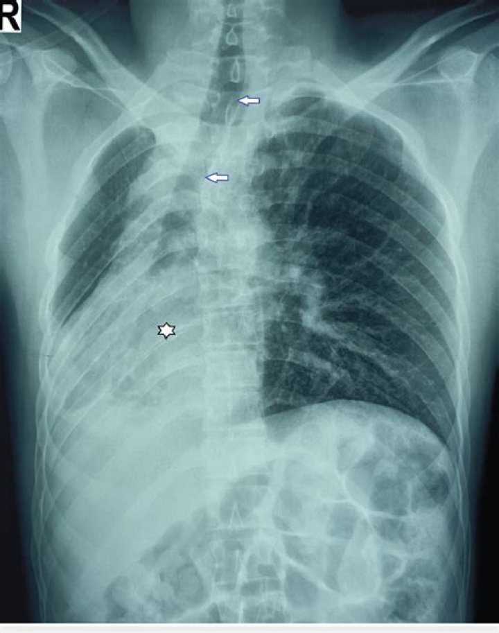 Will atelectasis go away?