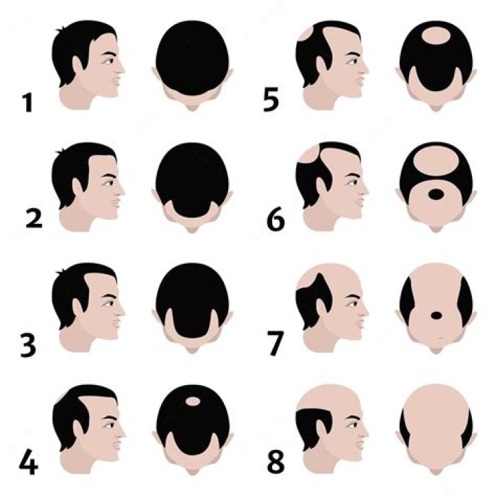 Will baldness be cured by 2025?