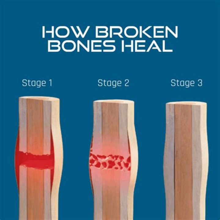 Will breaking a bone cause arthritis?