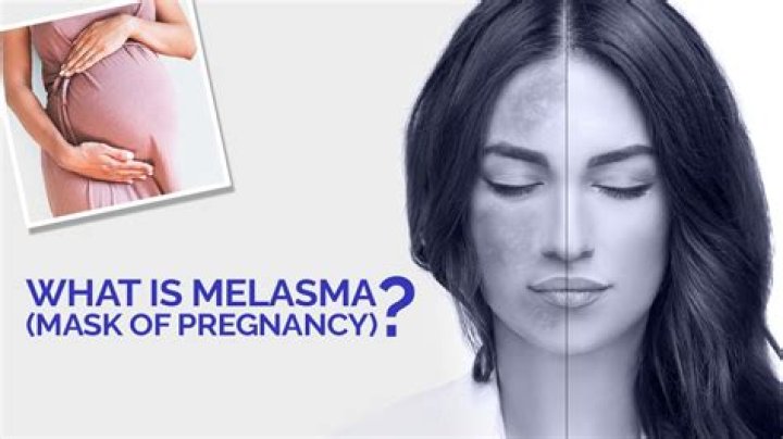 Will chloasma go away after pregnancy?