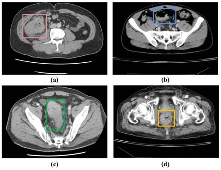 Will ct of abdomen show ulcers?