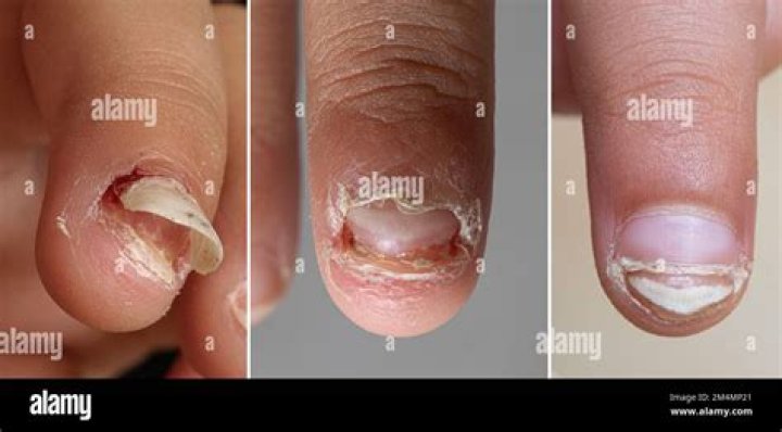 Will damaged nail grow back?