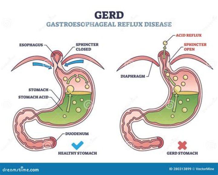 Will gastric bypass help gastritis?