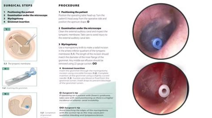 Will grommets stop ear infections?