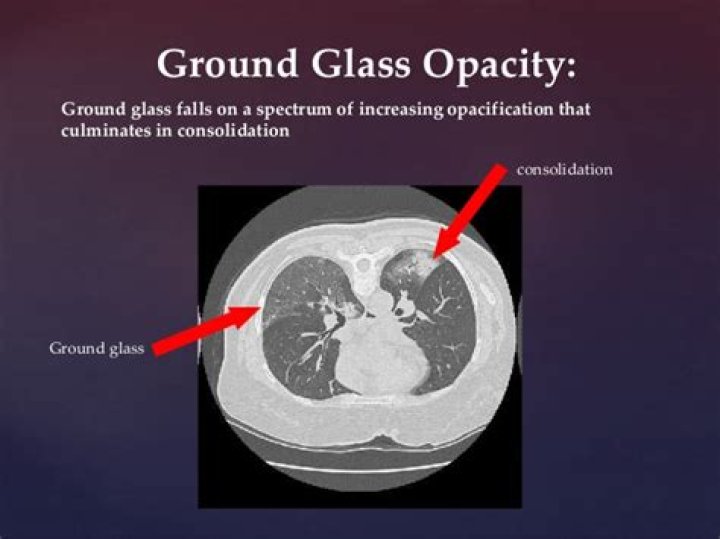 Will ground glass opacities go away?