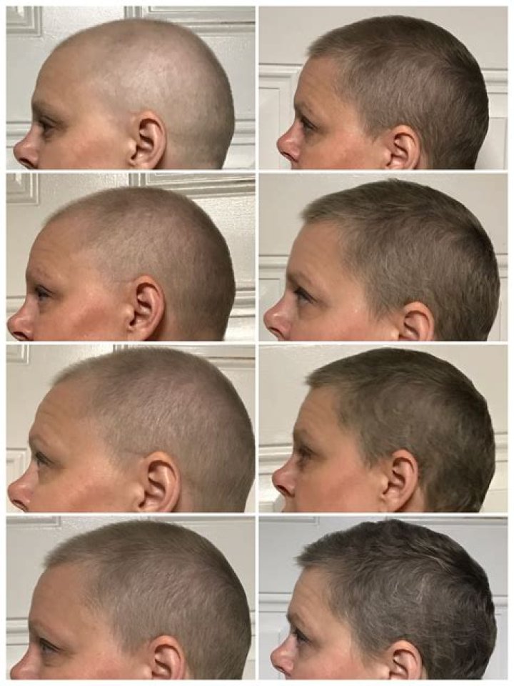Will hair regrowth after shaving head?
