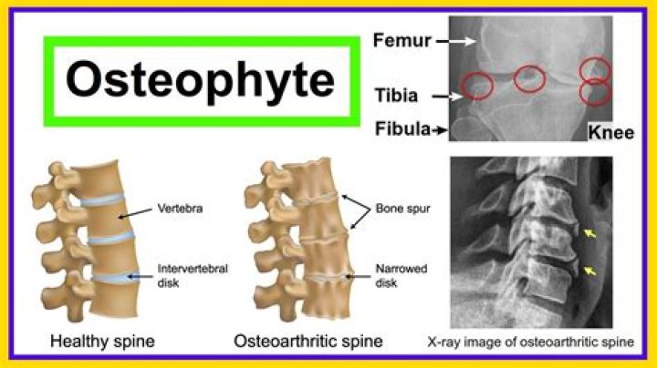 Will mri show osteophytes?