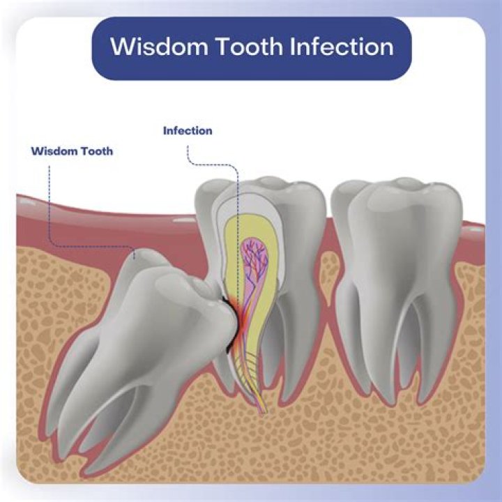 Will penicillin help a tooth infection?