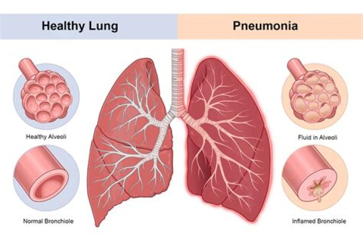 Will pneumonia cause hypotension?