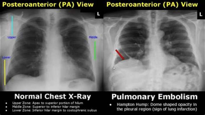 Will pulmonary embolism show on x ray?