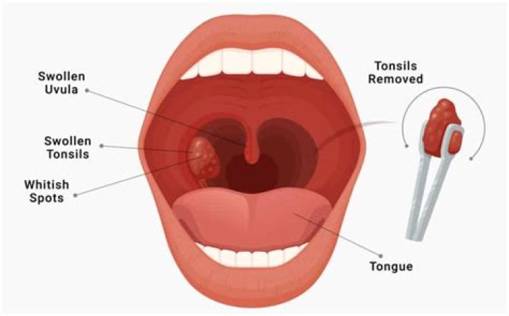 Will removing tonsils help with snoring?