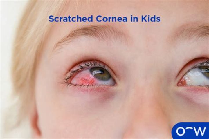 Will scratched cornea heal?