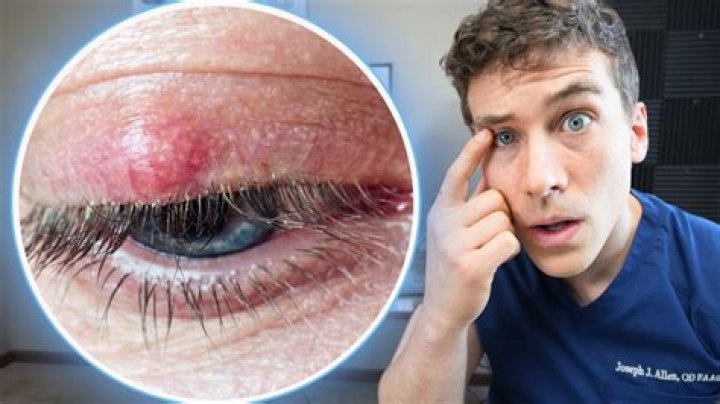 Will sebum go away?