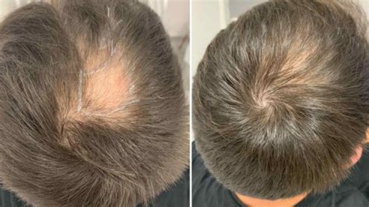 Will shorter hair help hair loss?