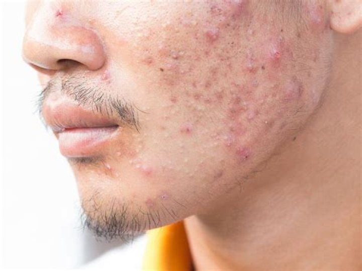 Will tea tree help blemishes?