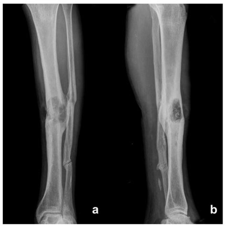 Will tibia go away?