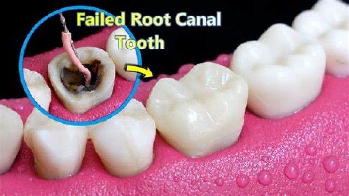 Will tooth discolored after root canal?
