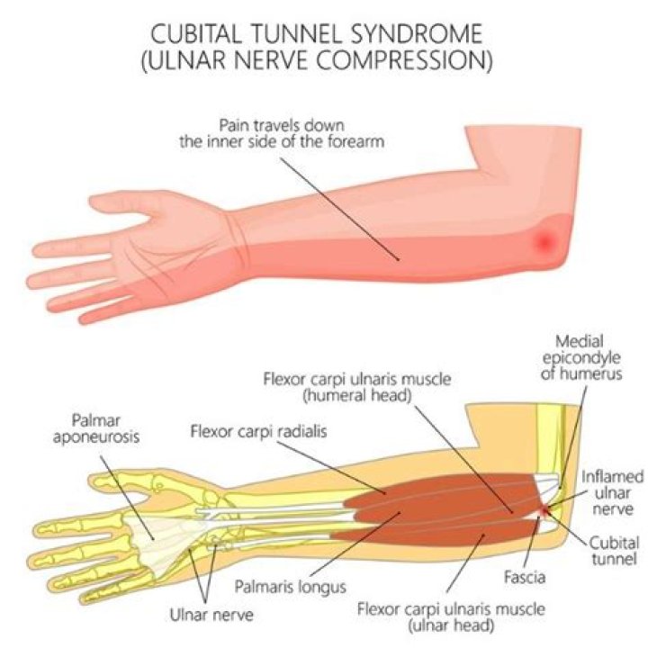 Will ulnar nerve entrapment go away?