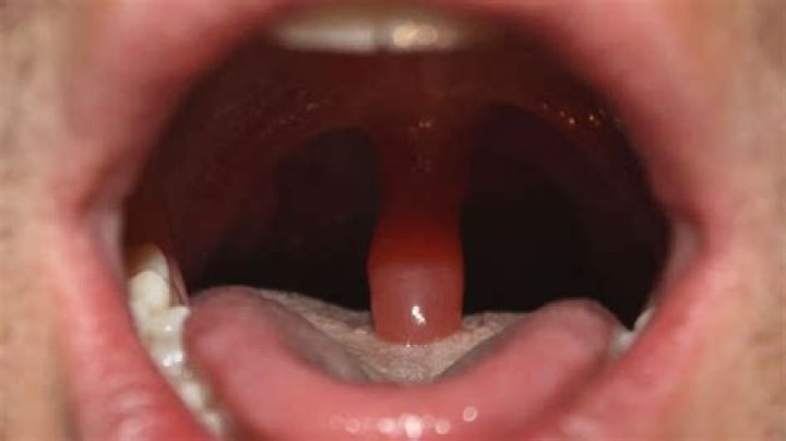 Will uvulitis go away on its own?