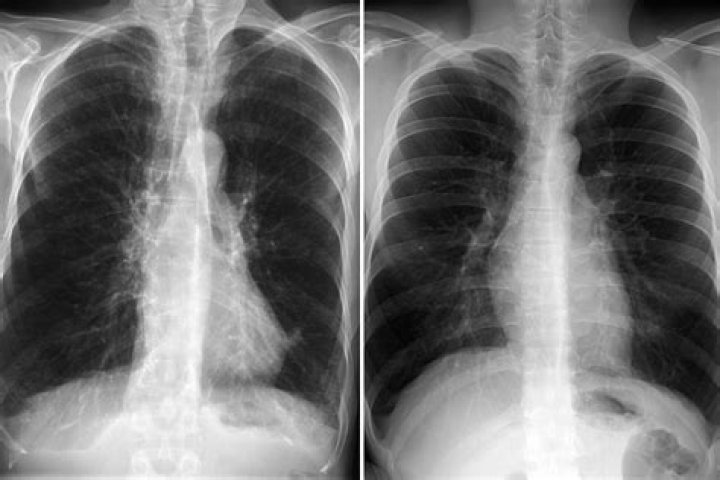 Would esophageal cancer show on a chest x ray?