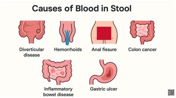 Would hemorrhoids cause blood in stool?