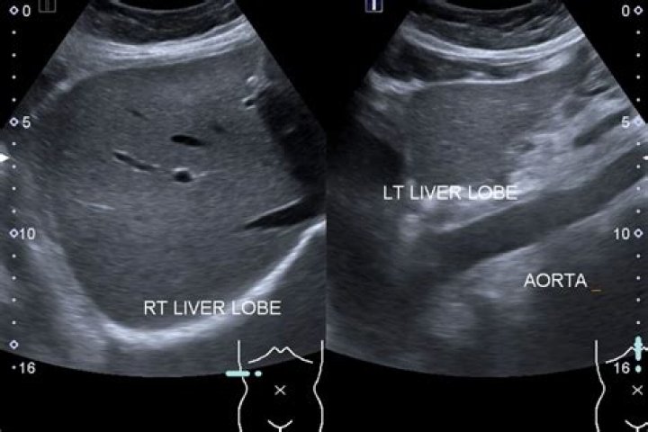 Would liver cancer show on ultrasound?