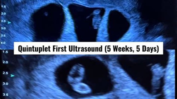 Would you see twins at 5 weeks?